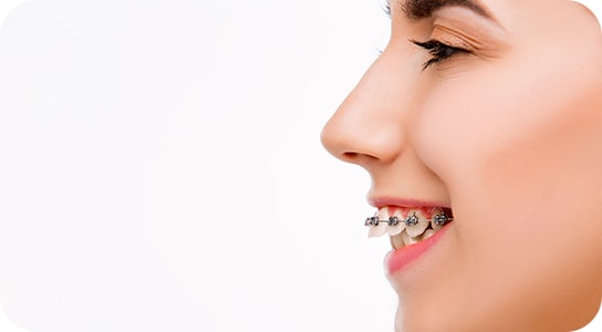 ceramic braces in jlt dubai