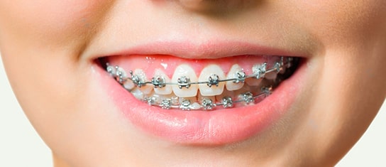 Dental-Braces1_03-min