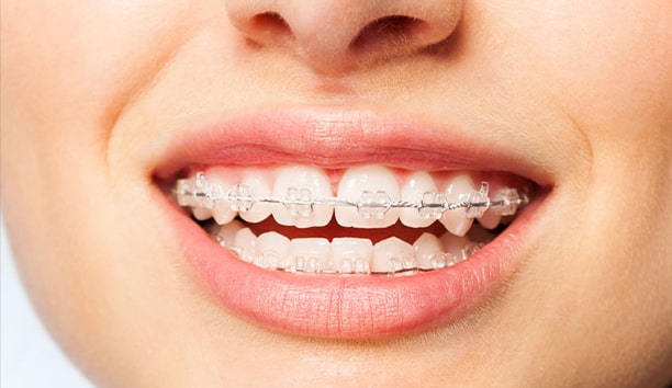 Dental-Braces2_03-min