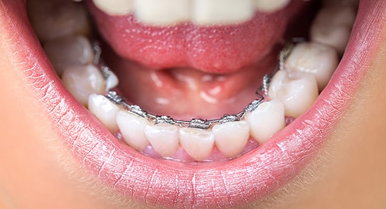 Dental-Braces3_03-min