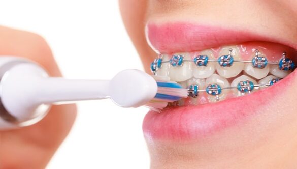 Brushing with braces on