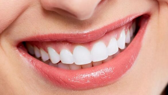 What do you know about veneers?