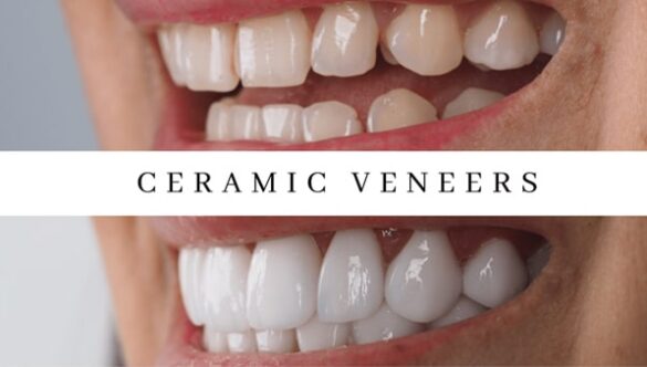 Unveiling the Smile Makeover – Ceramic vs. Composite Bonding Veneers