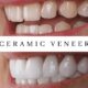 Unveiling the Smile Makeover – Ceramic vs. Composite Bonding Veneers