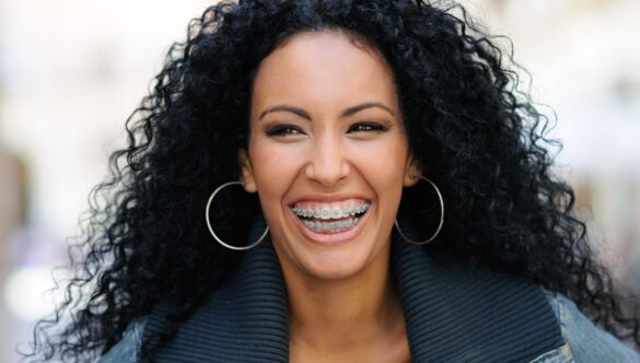 What Age Can You Get Braces in Dubai? Straighten Your Smile at Any Age